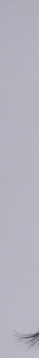 강남여드름흉터치료 확실하게 알고 있어야 관련 이미지 16