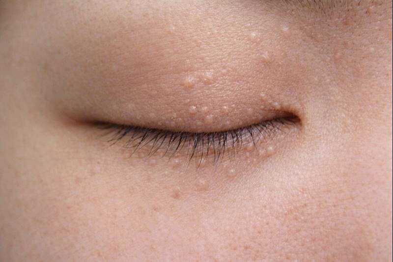 눈밑한관종제거 후기 및 비용 차이 관련 이미지 2