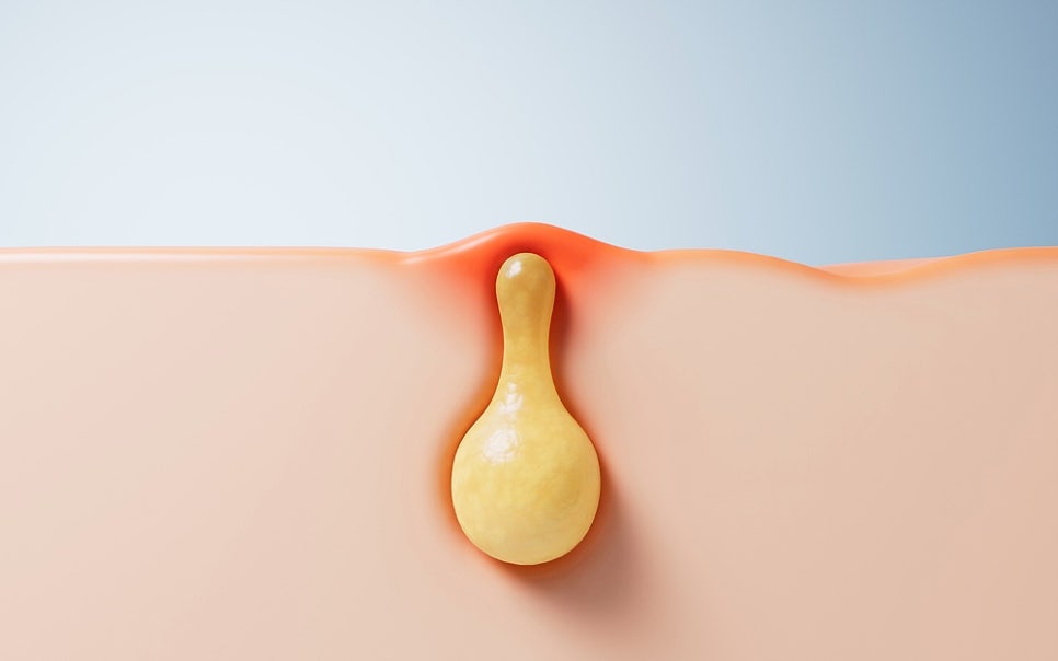 How to Manage Pus-Filled Acne in Summer and What to Watch Out For image 3