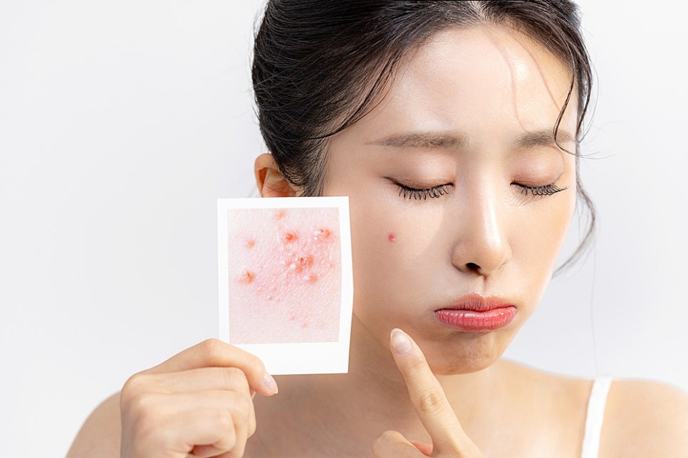 The Care Sequence Differs for Red Marks and Depressed Acne Scars in Bundang image 4