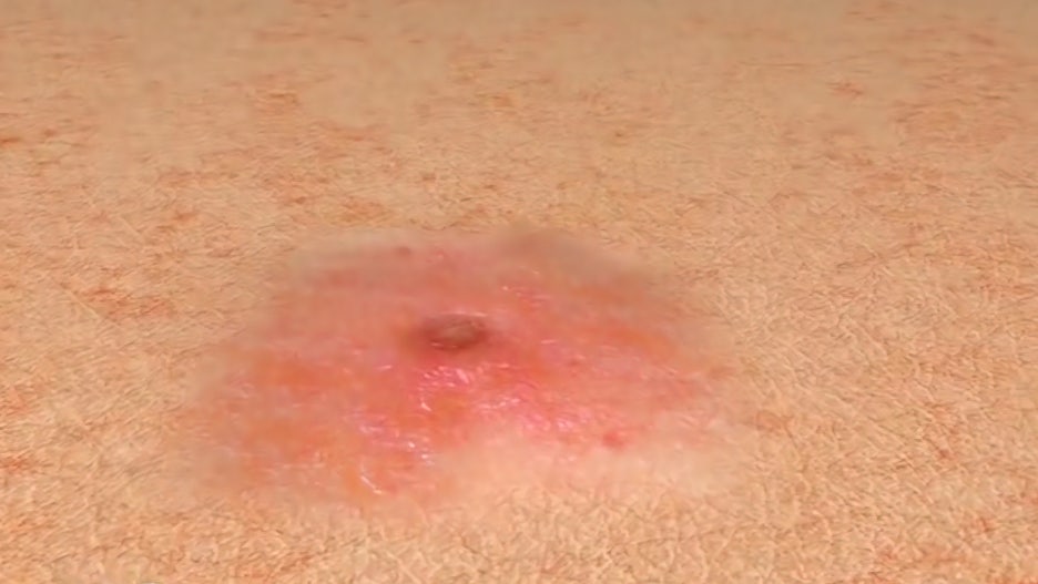 아트레이저 여드름 꼼꼼하게 관리해야 하기에 관련 이미지 5