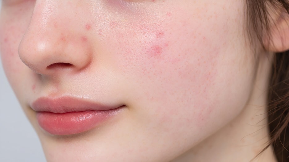 서초동여드름흉터 아프지 않게 관리하고자 관련 이미지 3