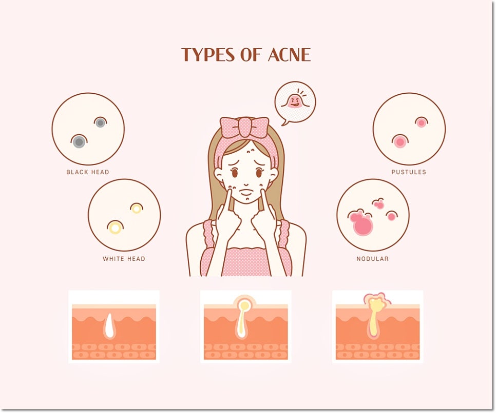 Tiny Bumps Around Gangnam Station: Are They Acne or Milia? The Clinic Director Explains How to Tell Them Apart image 3