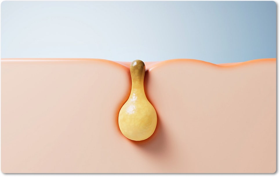 신논현역피부과 여드름 치료 흉터 관리를 위한 피부과전문의가 알려주는 방법 관련 이미지 8