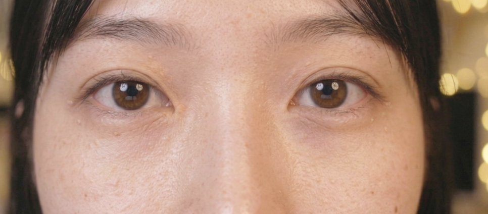 신논현 한관종 치료 비립종과 이렇게 다릅니다 관련 이미지 3