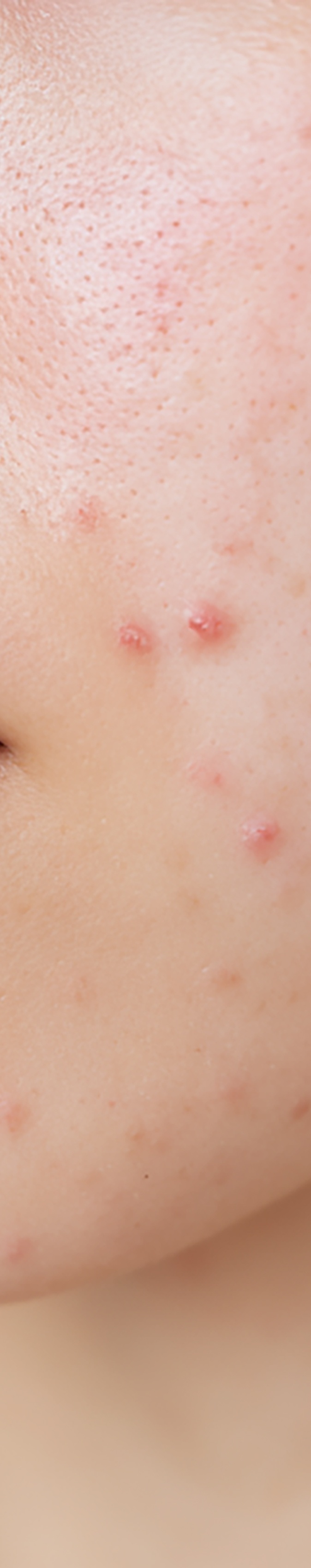 강남역여드름피부과 자국을 없애고 싶다면 관련 이미지 18