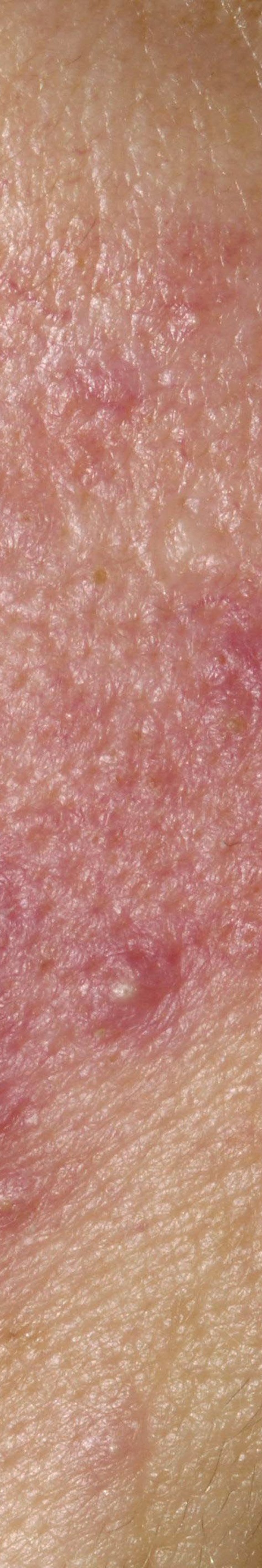 서초안면홍조 어떤 것부터 확인해야 할까 관련 이미지 19