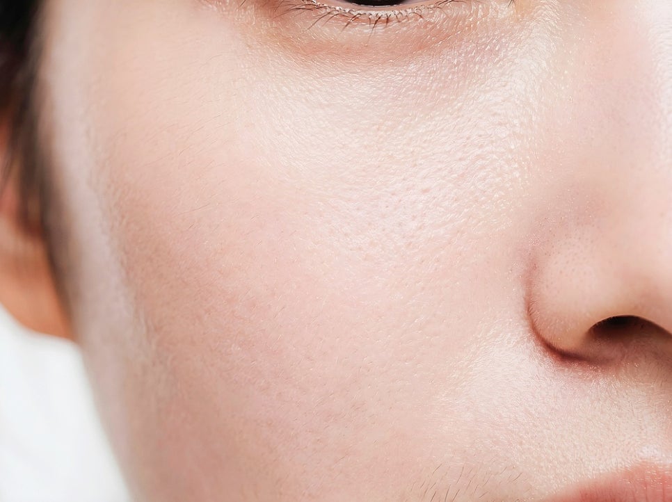 Why Does Melasma Reappear Even After Laser Toning in Nonhyeon? image 7