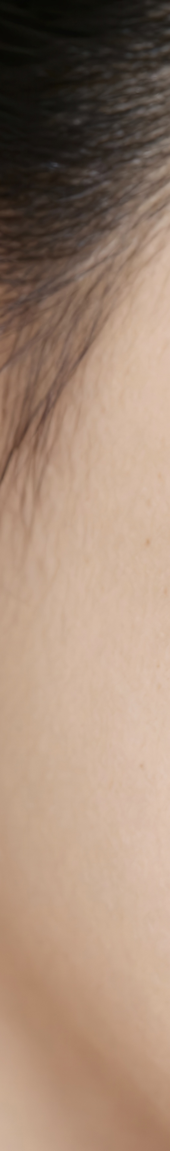 아트레이저 여드름 꼼꼼하게 관리해야 하기에 관련 이미지 15