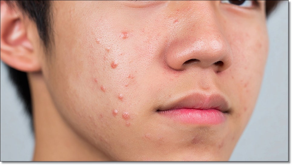 How Should You Care for Cystic Acne in Sinnonhyeon? image 3