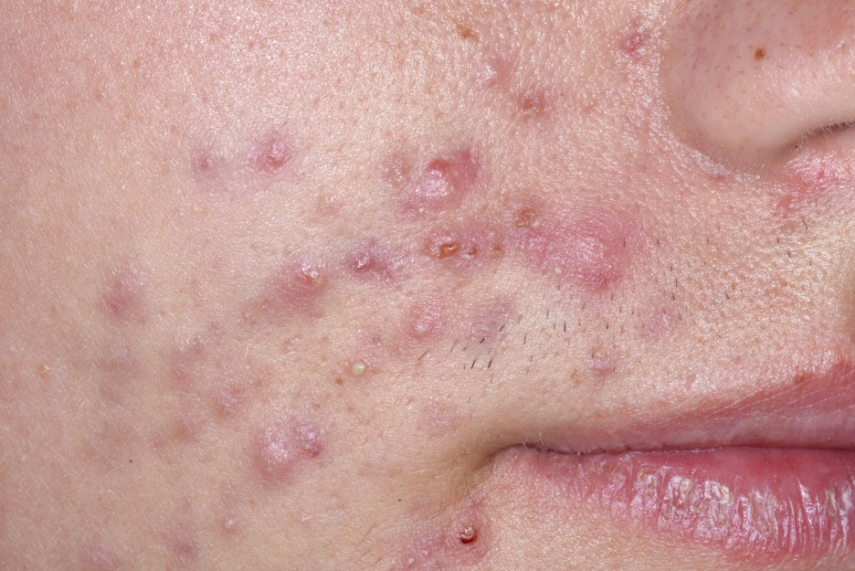 강남역여드름피부과 자국을 없애고 싶다면 관련 이미지 3