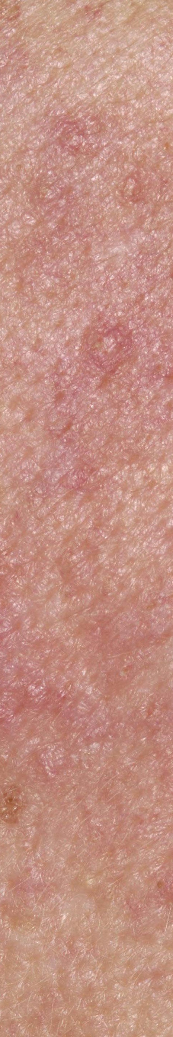 서초안면홍조 어떤 것부터 확인해야 할까 관련 이미지 17