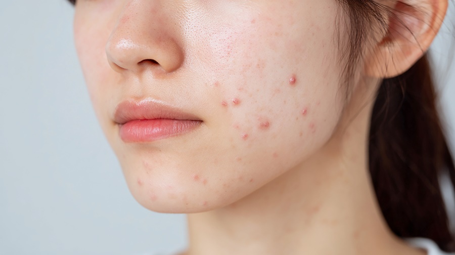 강남역 피부과 전문의 여드름 흉터 신경쓰인다면 관련 이미지 6