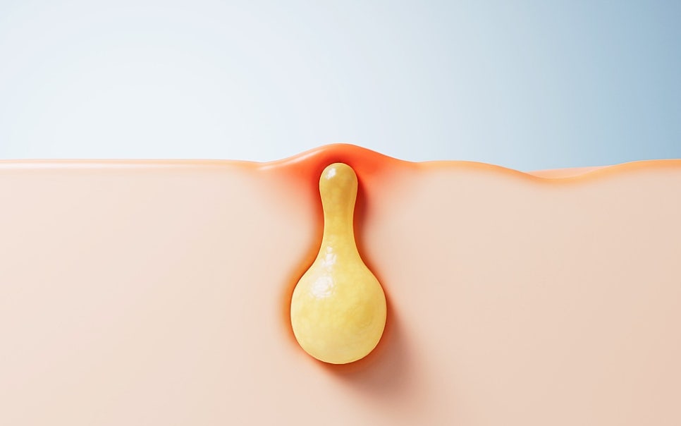 분당 여드름 치료 나이 지나면 사라진다는 말 믿어도 될까요 관련 이미지 7