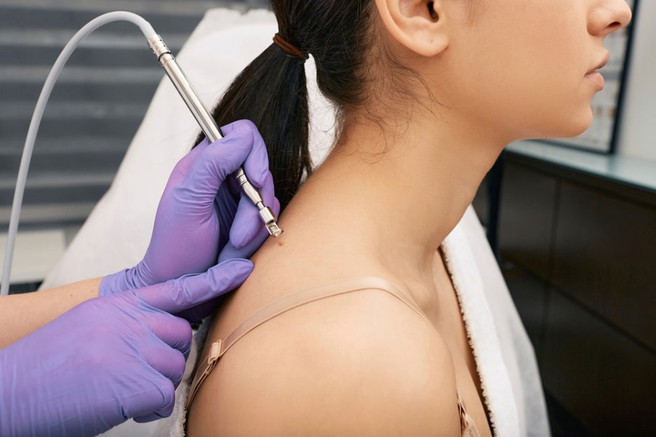 How to Prevent Hyperpigmentation with Regenerative Cream After Laser Treatment image 4