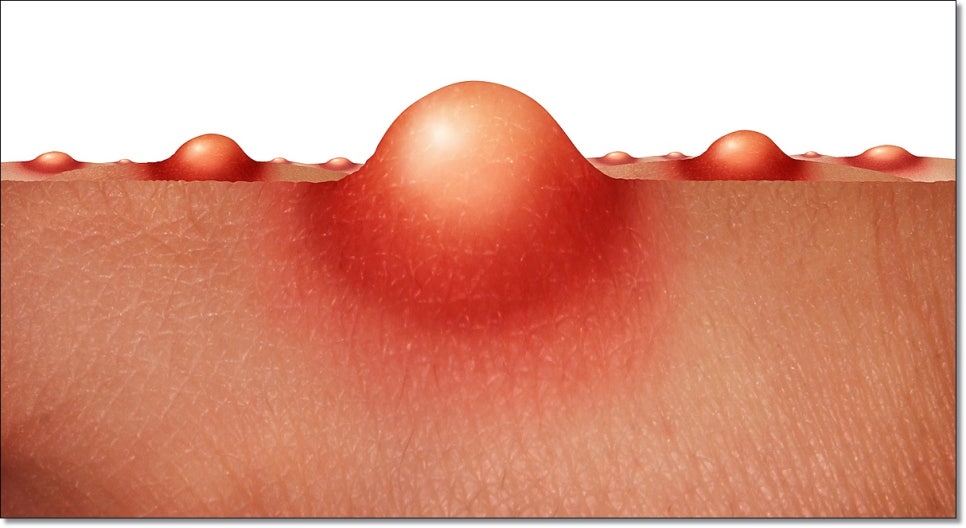 How Should You Care for Cystic Acne in Sinnonhyeon? image 7