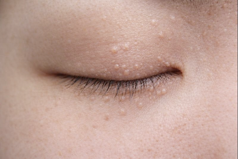 강남한관종제거 피부과 치료 관련 이미지 3