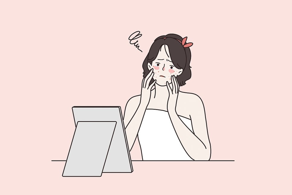 신논현 색소 레이저 피부에 남는 여드름 흔적 케어하는 방법 관련 이미지 3