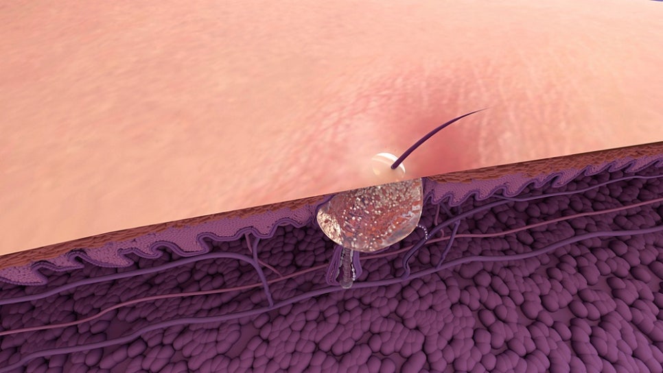 Shinnonhyeon Dermatology for Adult Acne in Men: Four Types of Male Acne and Treatment Approaches by Skin Condition image 5