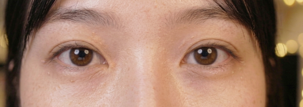Differences Between Syringoma and Milium: Bumpy Symptoms Around the Eyes image 3