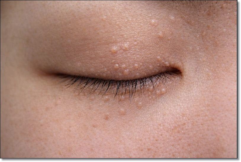 Why Makeup Applies Better After Removing Syringomas in Seocho-dong image 3