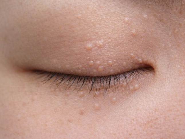 Differences Between Syringoma and Milium: Bumpy Symptoms Around the Eyes image 4