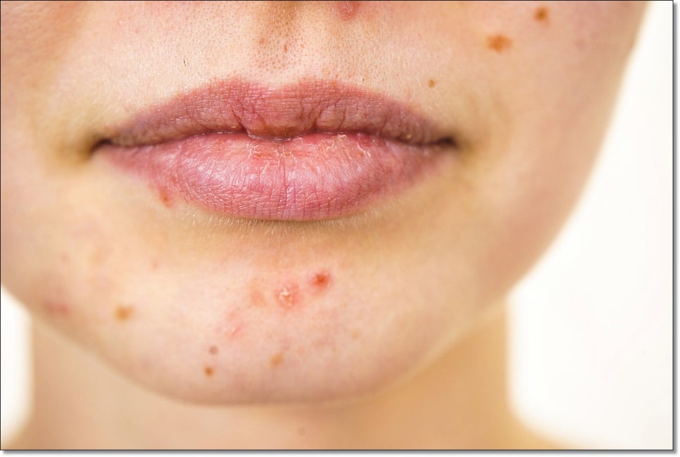 How Should You Care for Cystic Acne in Sinnonhyeon? image 11