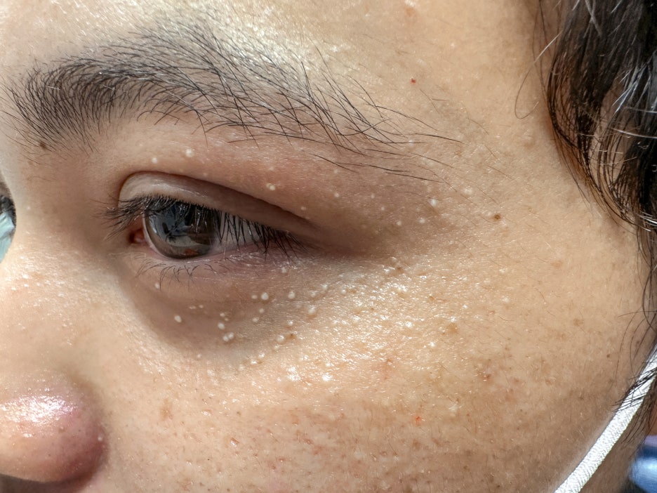 한관종 비립종 차이 어떻게 구분할 수 있을까 관련 이미지 5