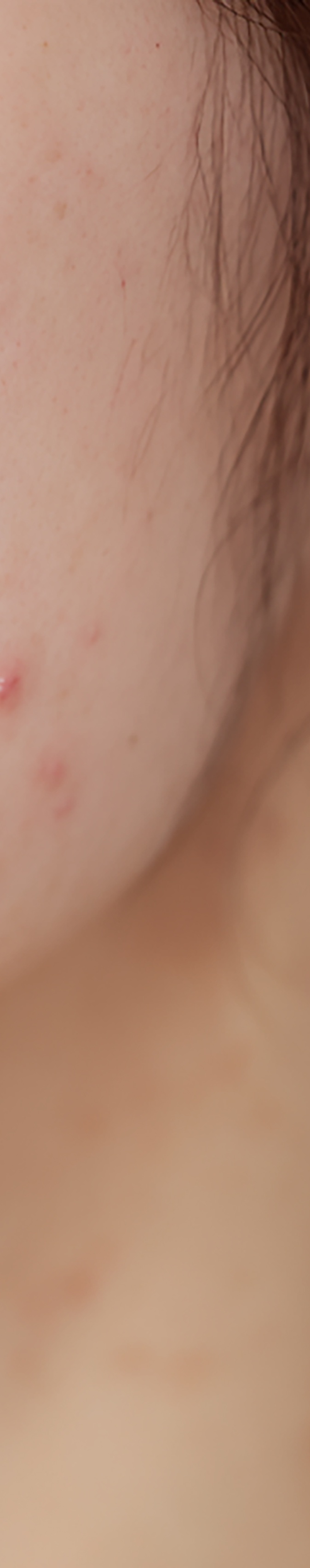 강남역여드름피부과 자국을 없애고 싶다면 관련 이미지 20