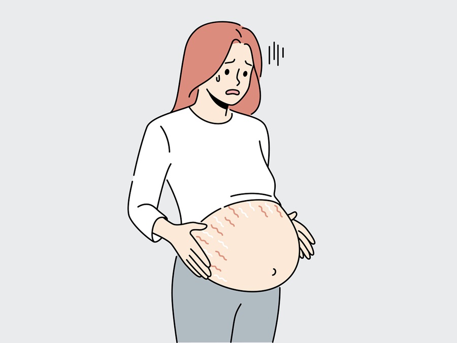 강남 튼살흉터제거 신경쓰인다면 관련 이미지 3