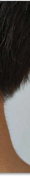 신논현역피부과 여드름 치료 흉터 관리를 위한 피부과전문의가 알려주는 방법 관련 이미지 41