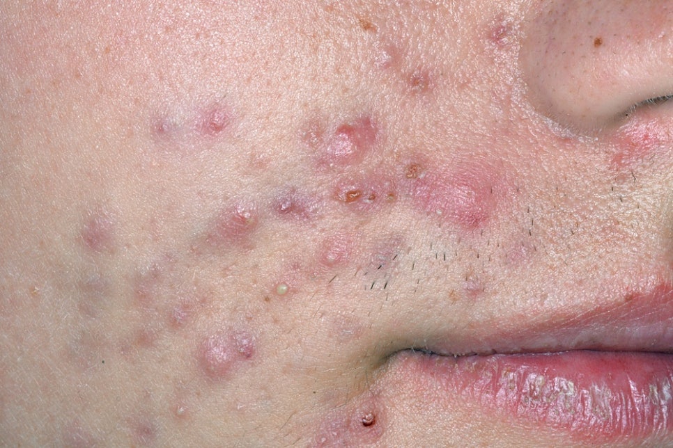 Shinnonhyeon Dermatology for Adult Acne in Men: Four Types of Male Acne and Treatment Approaches by Skin Condition image 4