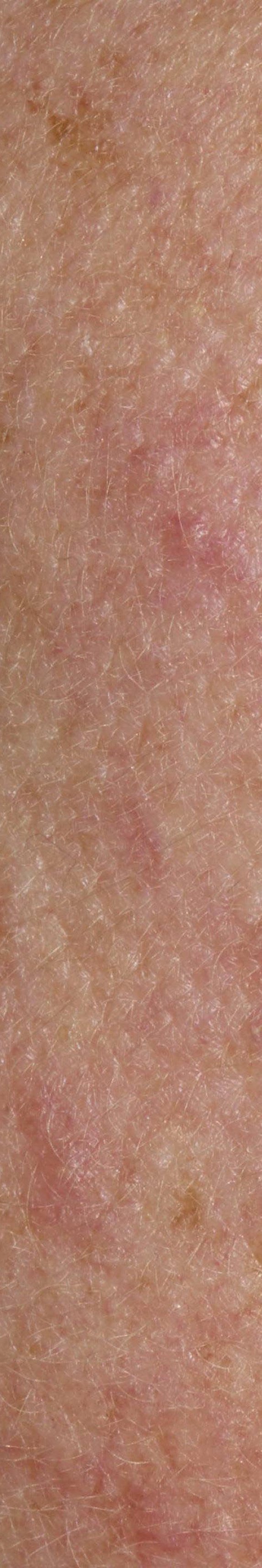 서초안면홍조 어떤 것부터 확인해야 할까 관련 이미지 15