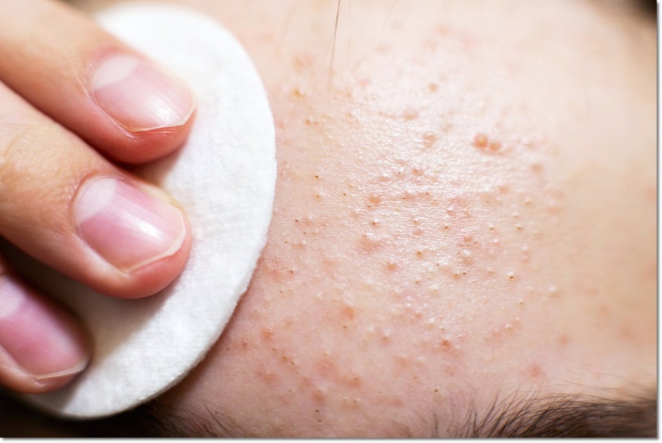 Tiny Bumps Around Gangnam Station: Are They Acne or Milia? The Clinic Director Explains How to Tell Them Apart image 4