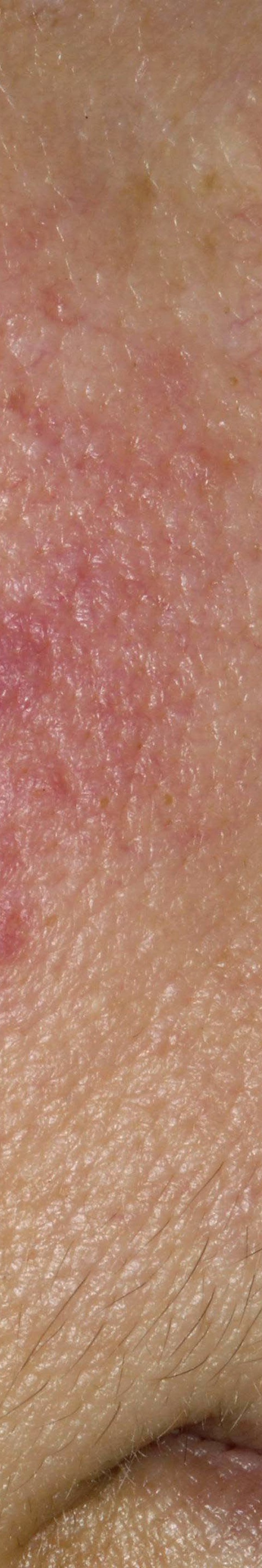 서초안면홍조 어떤 것부터 확인해야 할까 관련 이미지 20