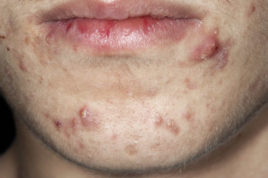 서초구 피부과 추천 여드름자국 때문에 고민된다면 관련 이미지 5