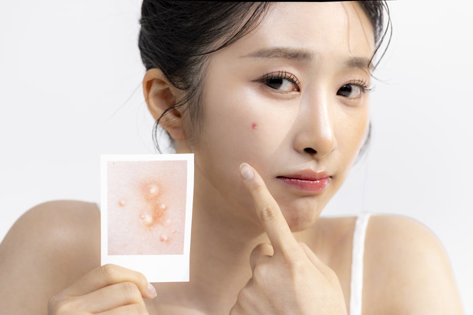 강남역여드름압출 아트레이저로 가능하기에 관련 이미지 3