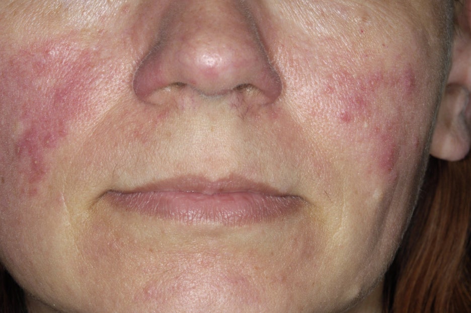 신논현 피부과 전문의 여드름자국을 없애고 싶다면 관련 이미지 5