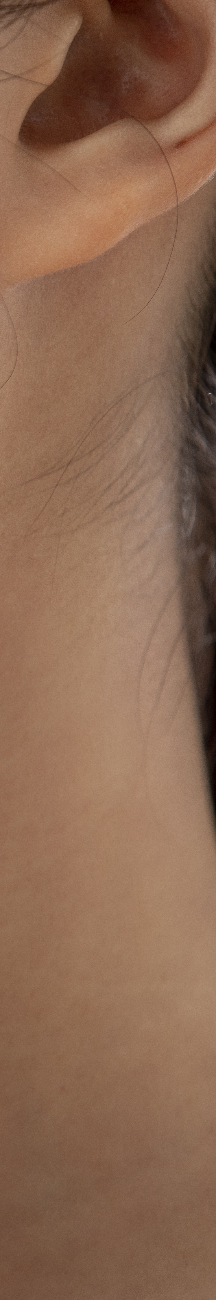 40대 리프팅 추천 시술 궁금하신 분들 주목 관련 이미지 33