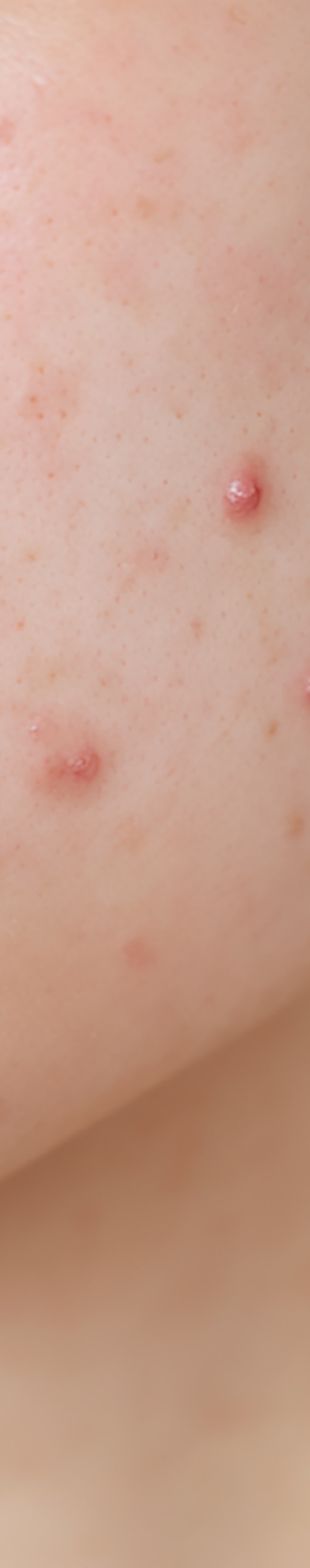 강남역여드름피부과 자국을 없애고 싶다면 관련 이미지 19