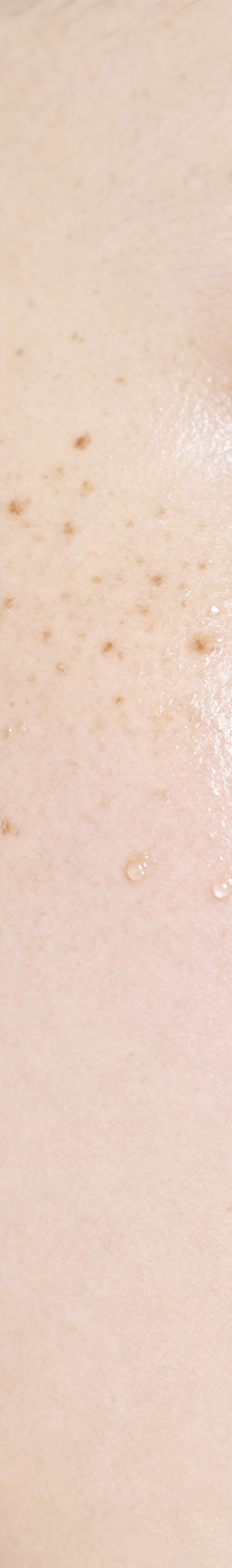 아트레이저 여드름 꼼꼼하게 관리해야 하기에 관련 이미지 17