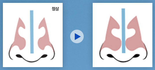 [코코라인의원 칼럼] 코가 자주 막히세요? 그럼 비갑개 비대증를 의심해 보세요! 관련 이미지 1