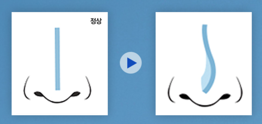 [Cocoline Clinic] For rhinitis and nose surgery, what kind of medical team should you choose? image 2