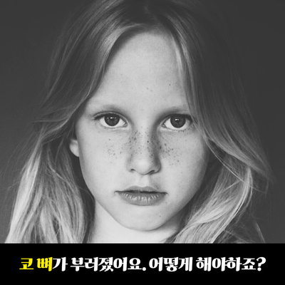 코뼈 (비골) 골절 수술 보험에 대하여 관련 이미지 5