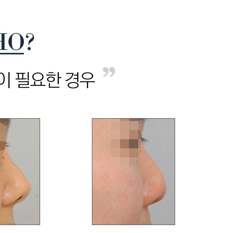 If You're Curious About Autologous Rib Cartilage, Click Here! image 10
