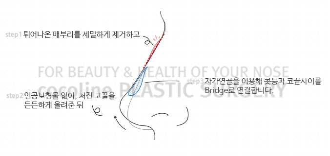 코코라인 무보형물 코성형이란? 관련 이미지 1