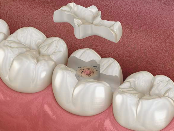 마곡역치과_4. 인레이 치료 후 통증 생기는 이유 [ 자연스러운 회복? 문제 신호?] 관련 이미지 4