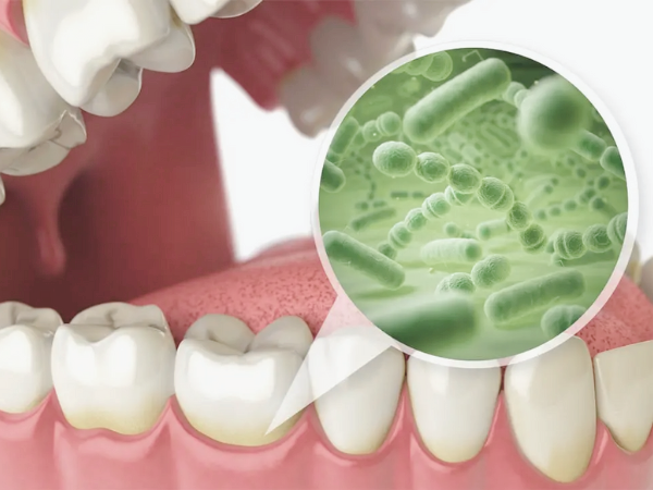 마곡치과_6. 잇몸치료 후 관리법, 정기검진 주기 꼭 지켜야 하는 이유 관련 이미지 1