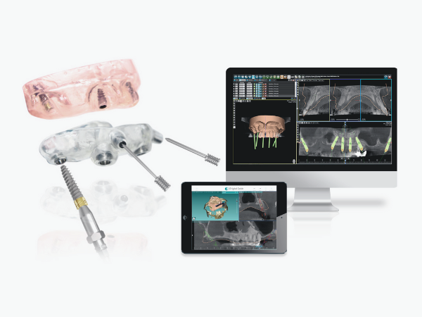 Magok-dong Dental Clinic_4. Full-Mouth Implant Surgery Process: A Step-by-Step Look image 2