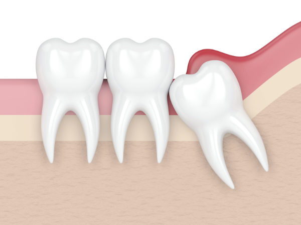 마곡동치과_2. 사랑니염증 증상과 대처, 이렇게 시작되면 한 번은 확인하세요 관련 이미지 1